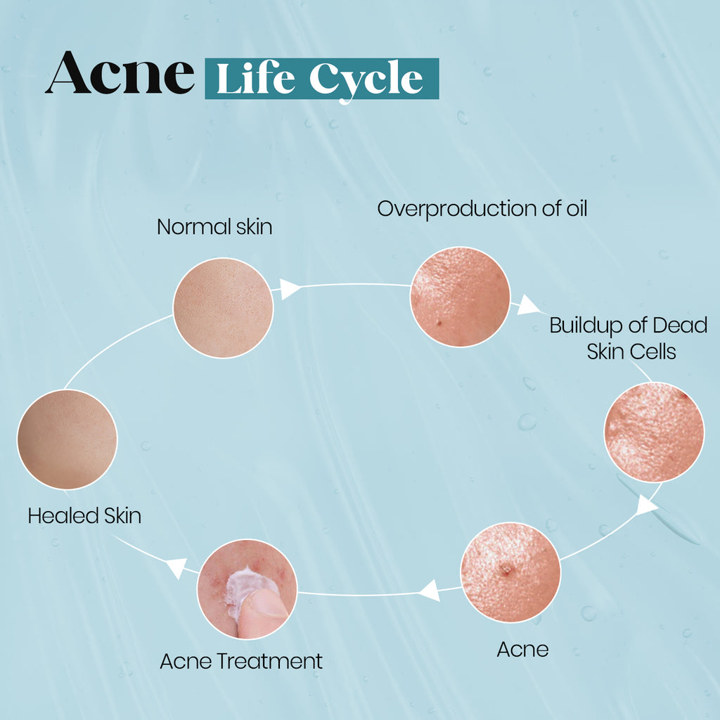 Just Awe 5 In-1 Acne Face Moisturizer - 50gm