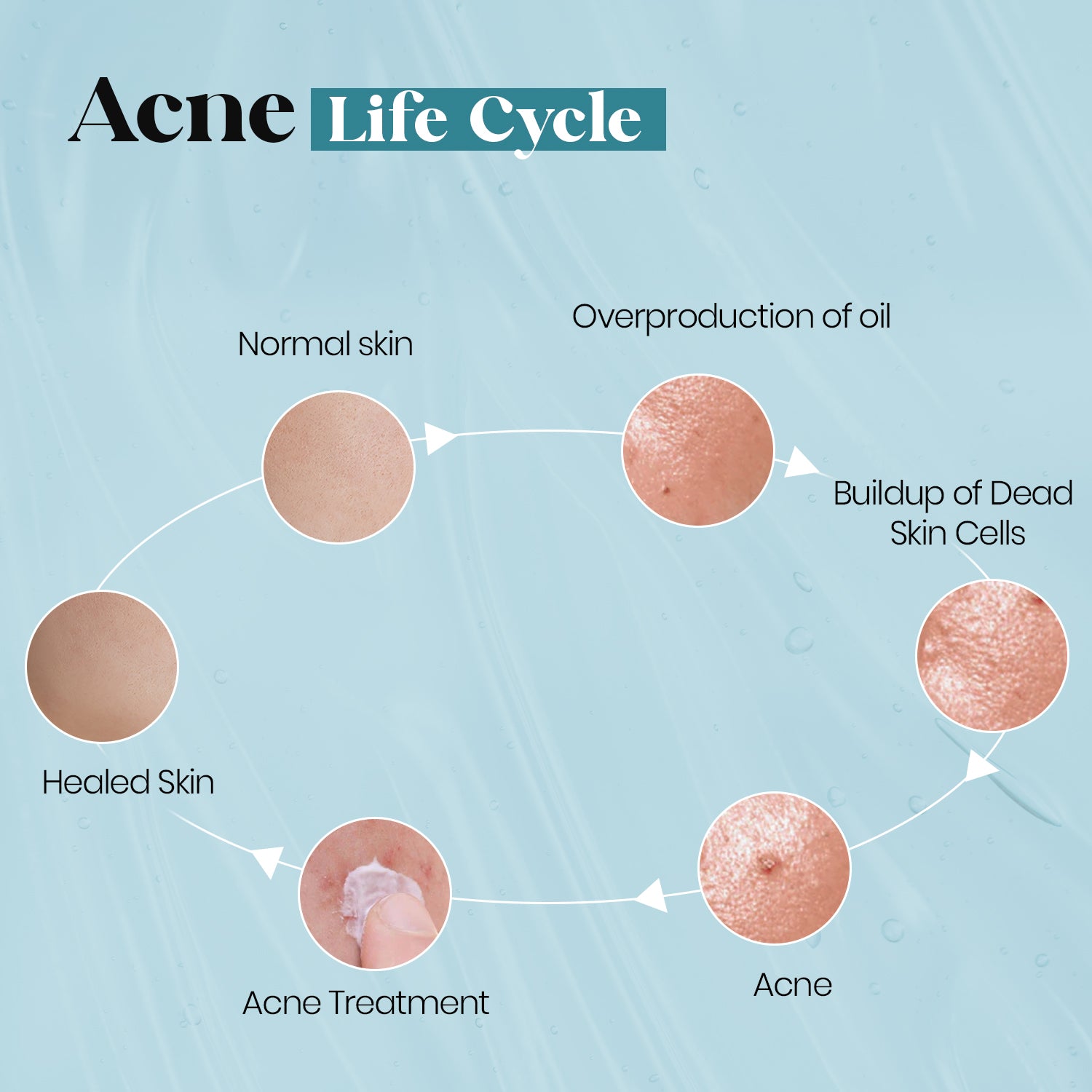 Just Awe 5 In-1 Acne Face Moisturizer - 50gm